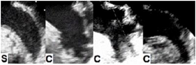 Complex Left Atrial Appendage Morphology Is an Independent Risk Factor for Cryptogenic Ischemic Stroke
